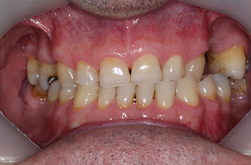 Worn-Teeth-001
