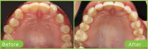 invisalign-fotini-before-after-case